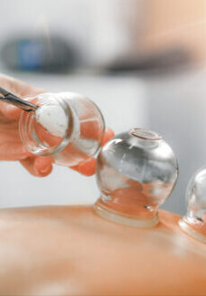 Detail of a woman therapist hands giving cupping treatment on back.